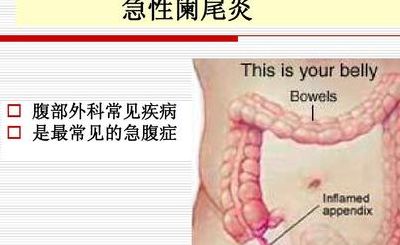 阑尾炎是哪个部位疼 位置图(阑尾在哪个位置?慢性阑尾炎要怎么治疗？)